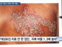 [쿠키건강뉴스] “대상포진 치료 안 하면 치매 발생 위험 커져”