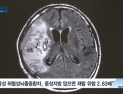 [쿠키건강뉴스] “중성지방 수치 높으면 급성 뇌졸중 재발 위험 커져”